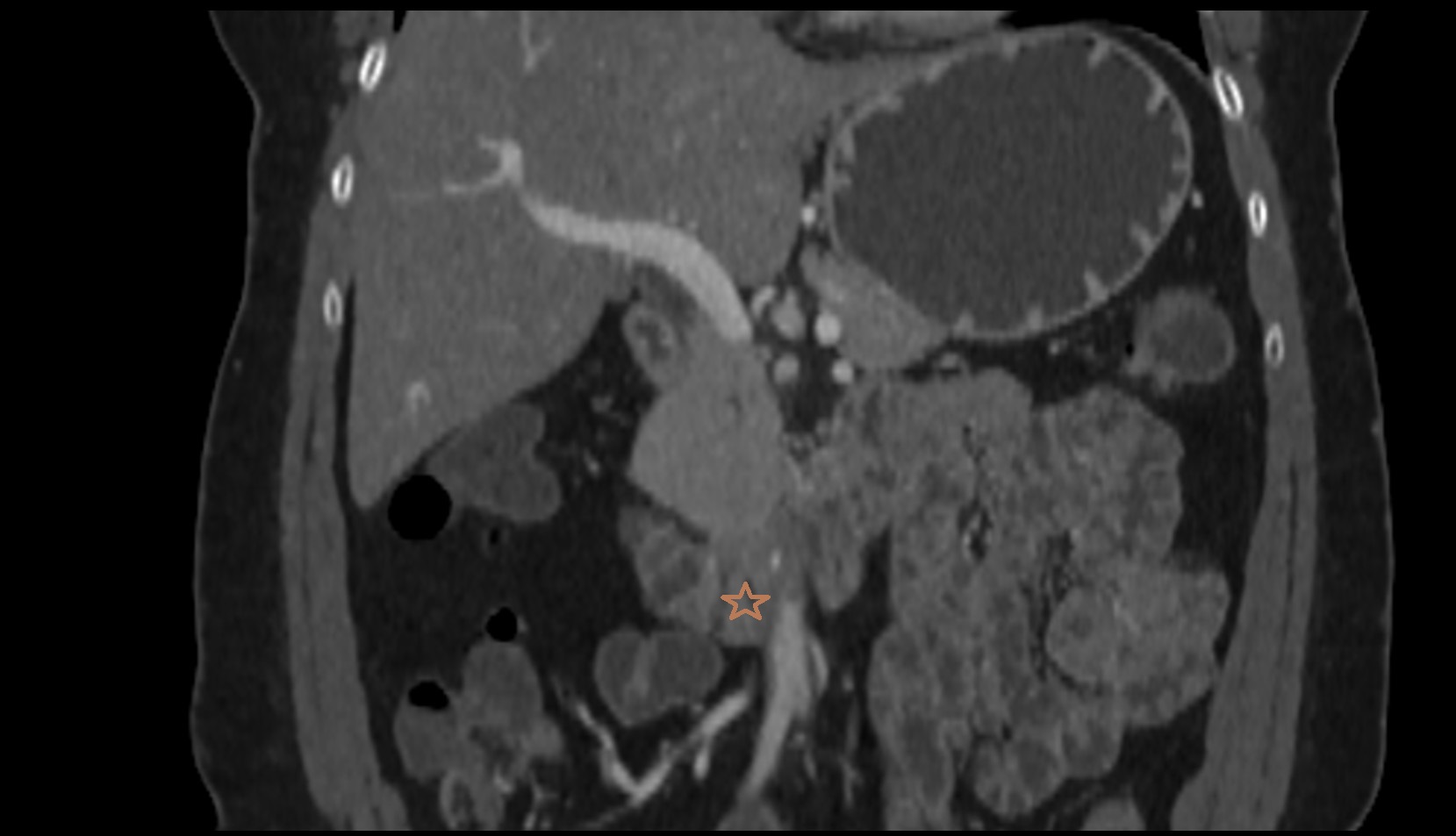 Duodenum – Horizontal part (D3)  CT  coronal image