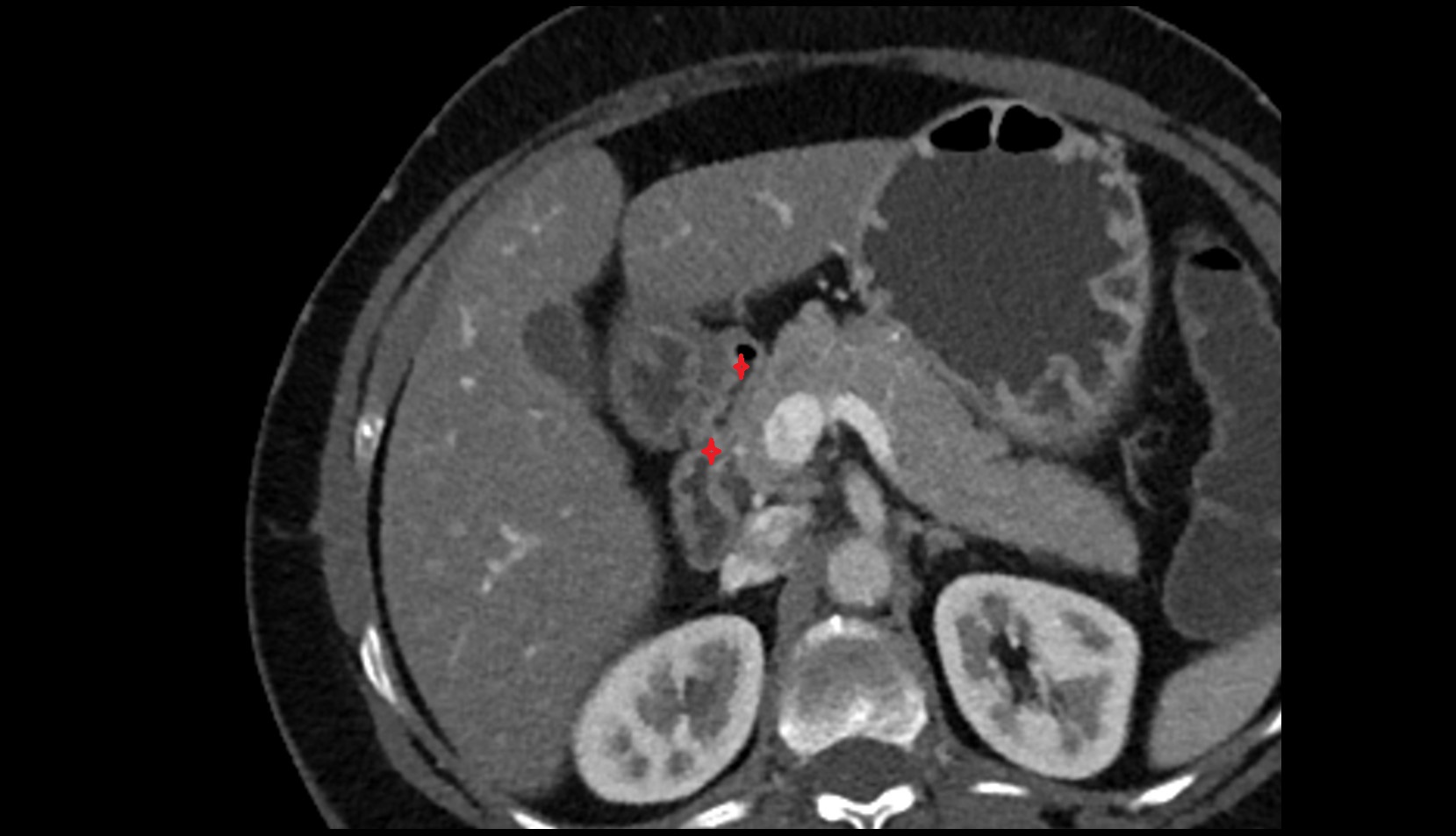 Duodenum – Superior part (D1) ct axial image
