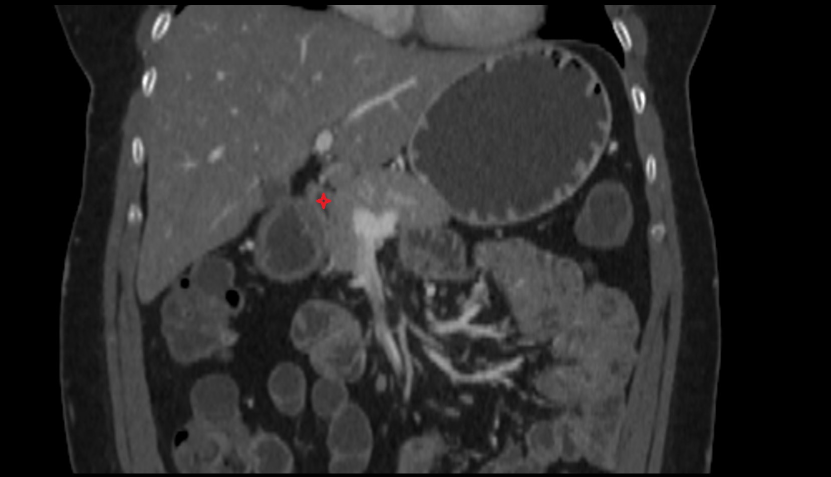 Duodenum – Superior part (D1) ct coronal image