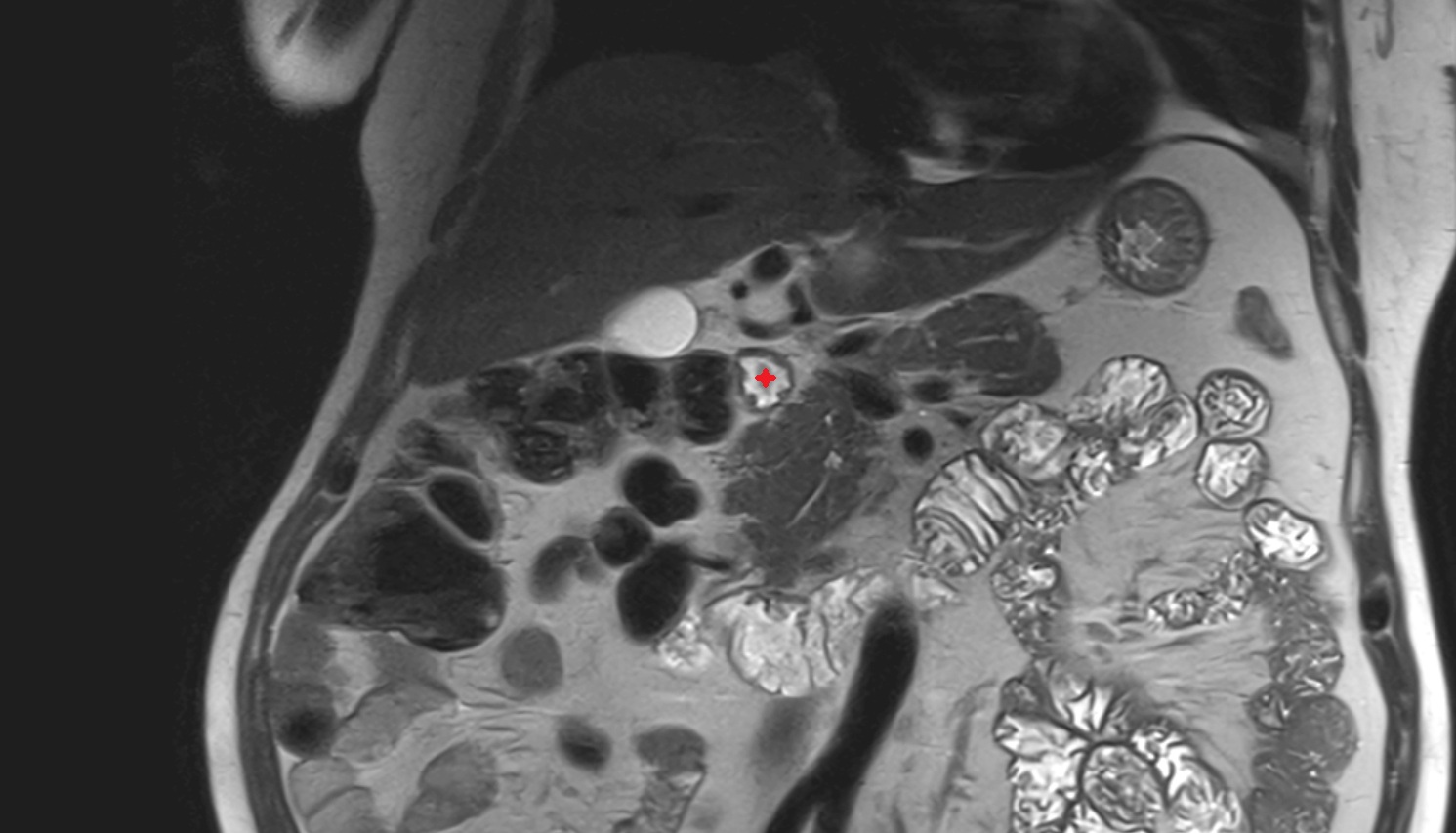 Duodenum – Superior part (D1) ct coronal image   MRI coronal  anatomy  image -img-00000-00000