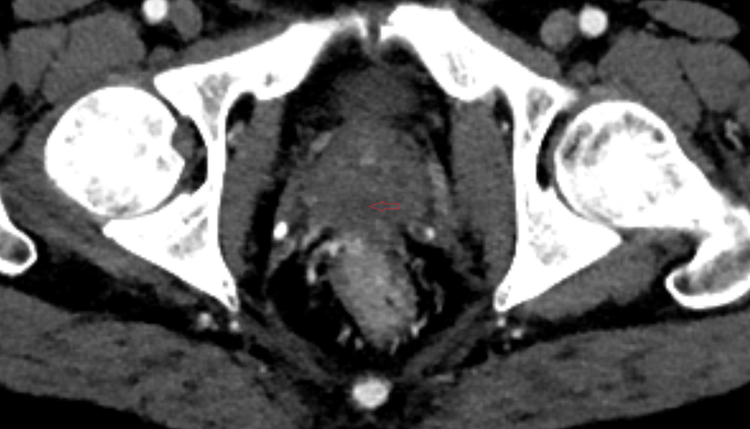 Ejaculatory duct  ct  axial  anatomy  image-img-00000-00000