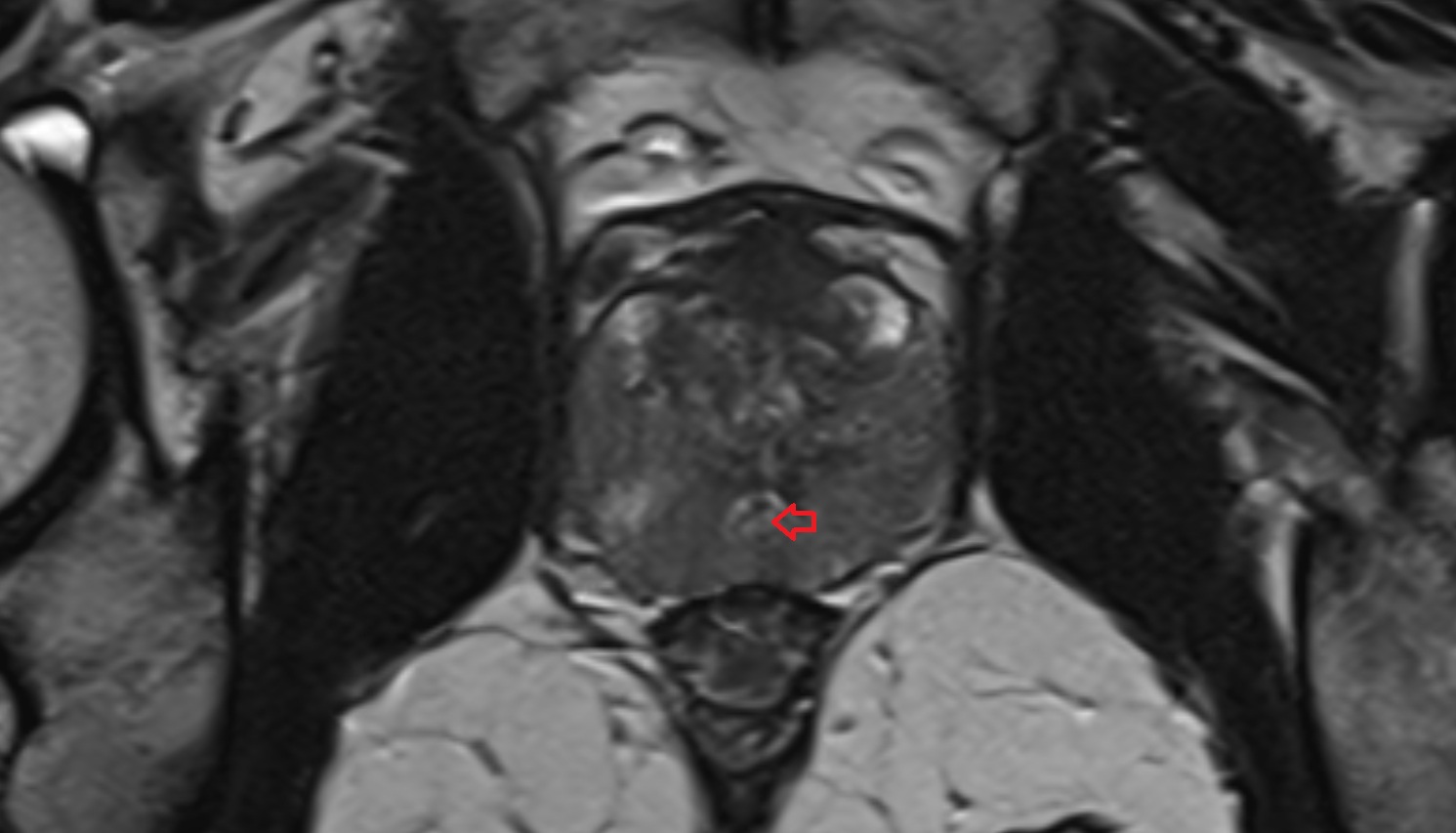 Ejaculatory duct  mri axial  anatomy  image-img-00000-00000
