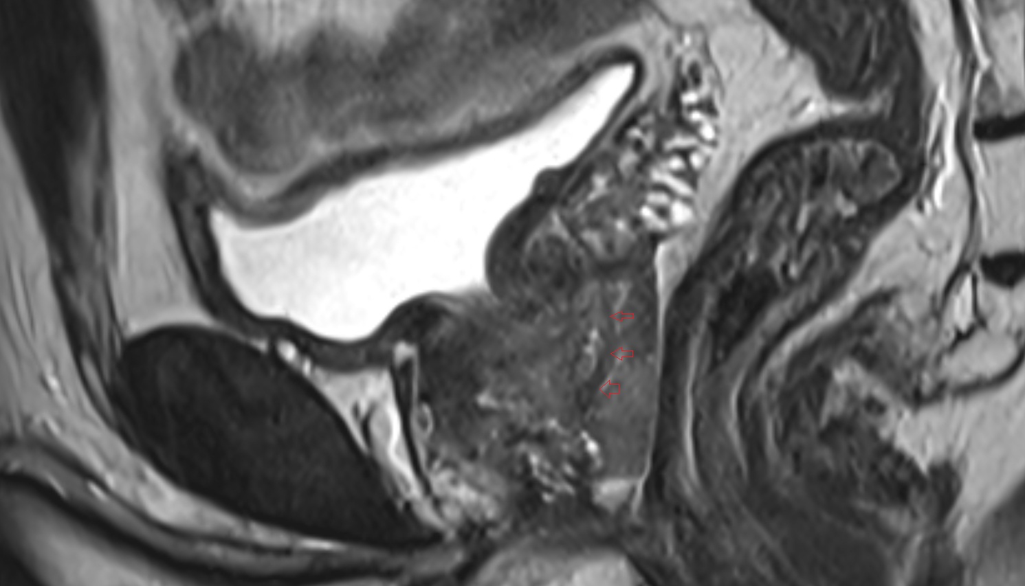 Ejaculatory duct  mri sagittal  anatomy  image-img-00000-00000