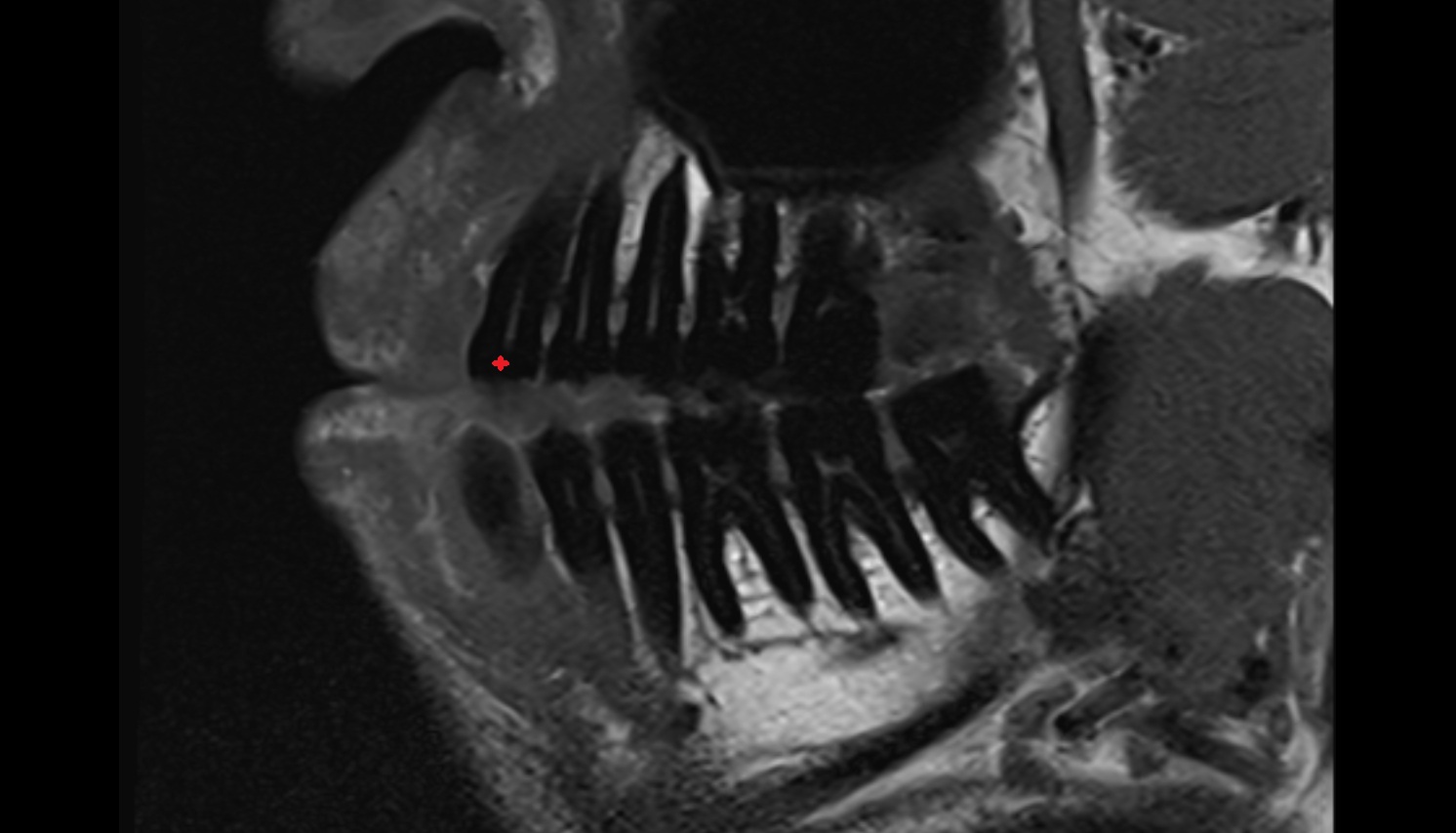 Enamel of Canine Tooth  mri sagittal  image -img-00000-00000