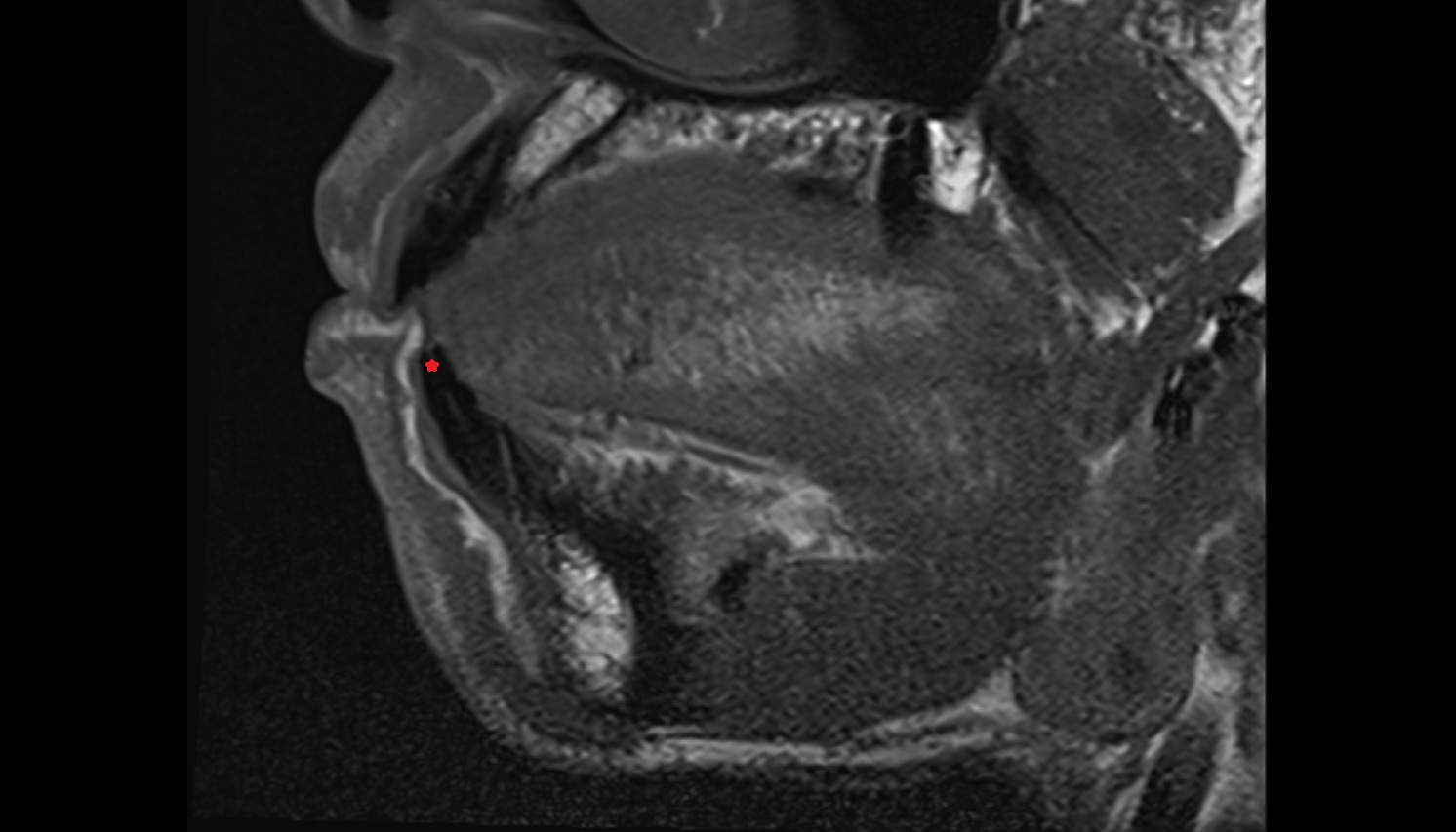 Enamel of Lower Incisor Tooth  mri sagittal  image -img-00000-00000