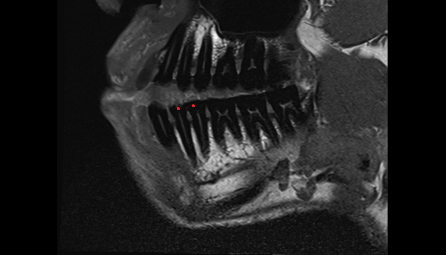 Enamel of Lower Premolar Tooth  mri sagittal  image -img-00000-00000