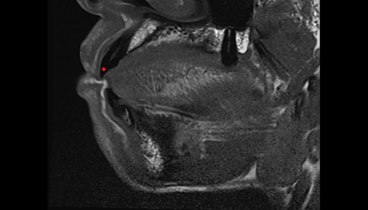 Enamel of Upper Incisor Tooth  mri sagittal  image -img-00000-00000
