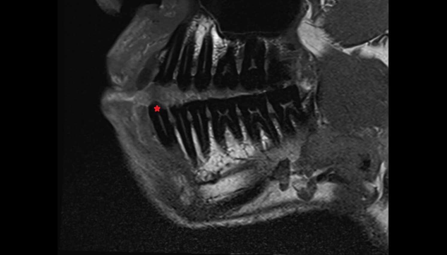 Enamel of lower canines tooth  mri sagittal  image -img-00000-00000