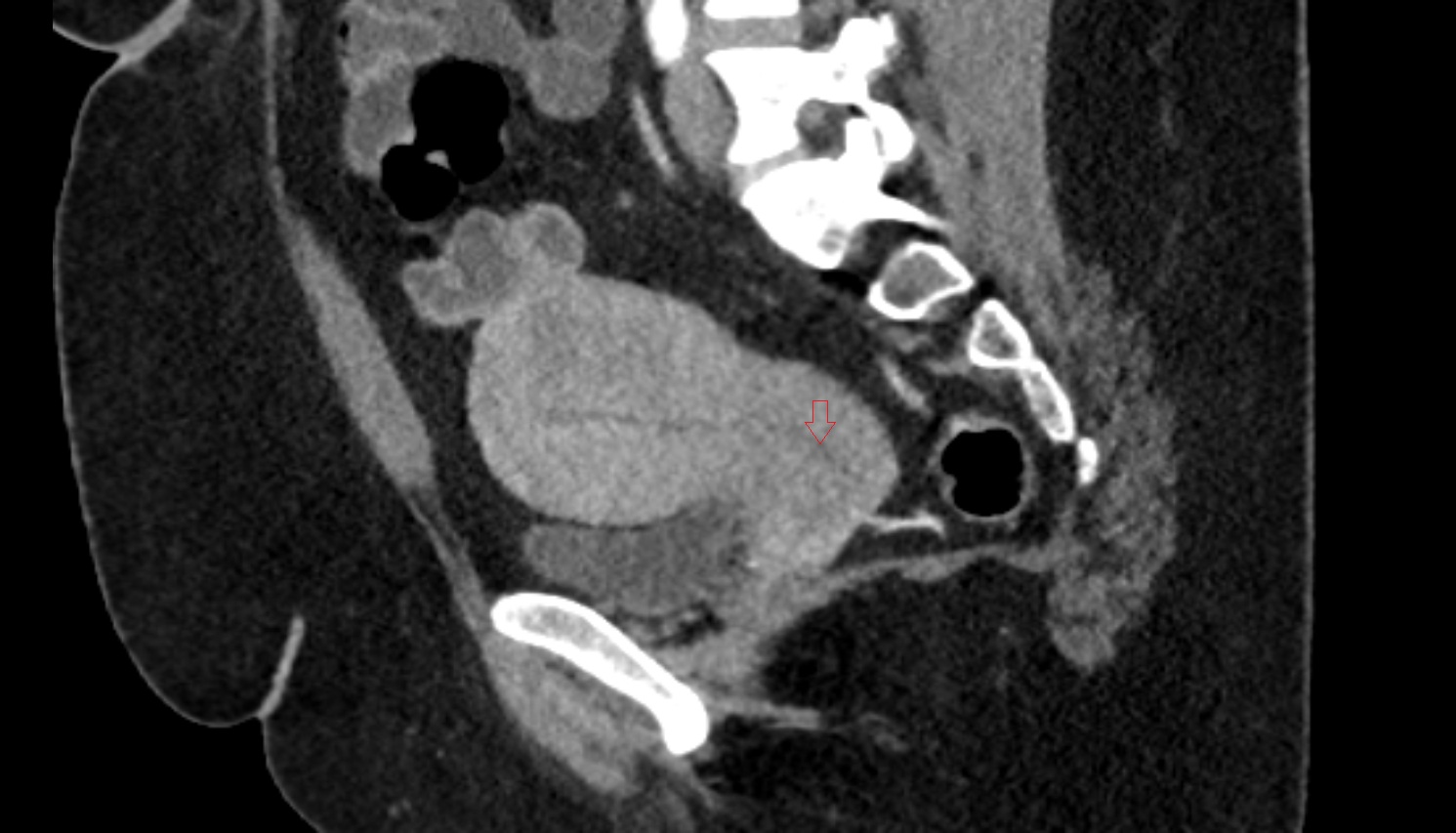 Endocervical canal  CT SAGITTAL  anatomy  image-img-00000-00000
