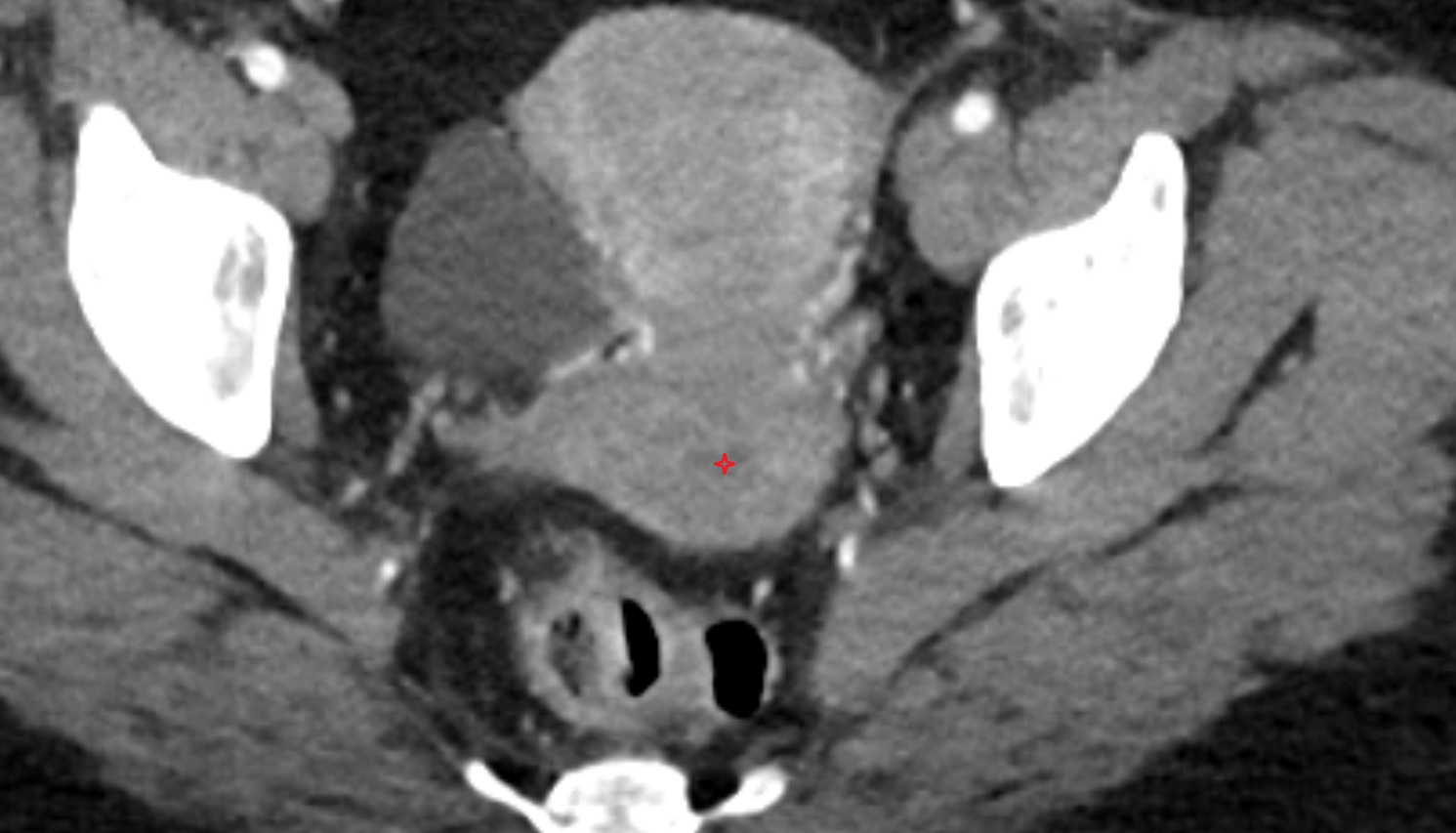 Endocervical canal  CT axial  anatomy  image-img-00000-00000