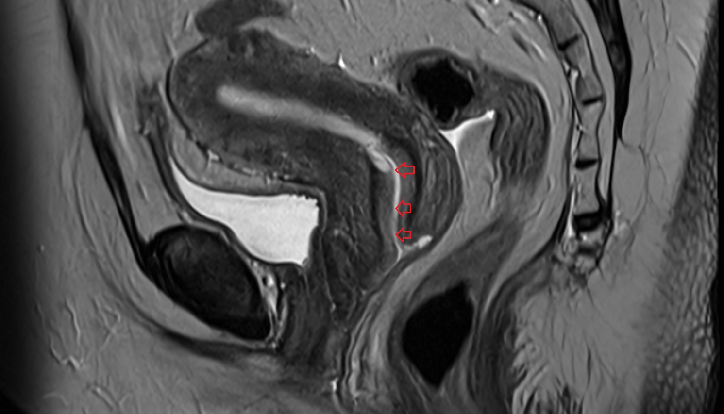 Endocervical canal  MRI  SAGITTAL  anatomy  image-img-00000-00000