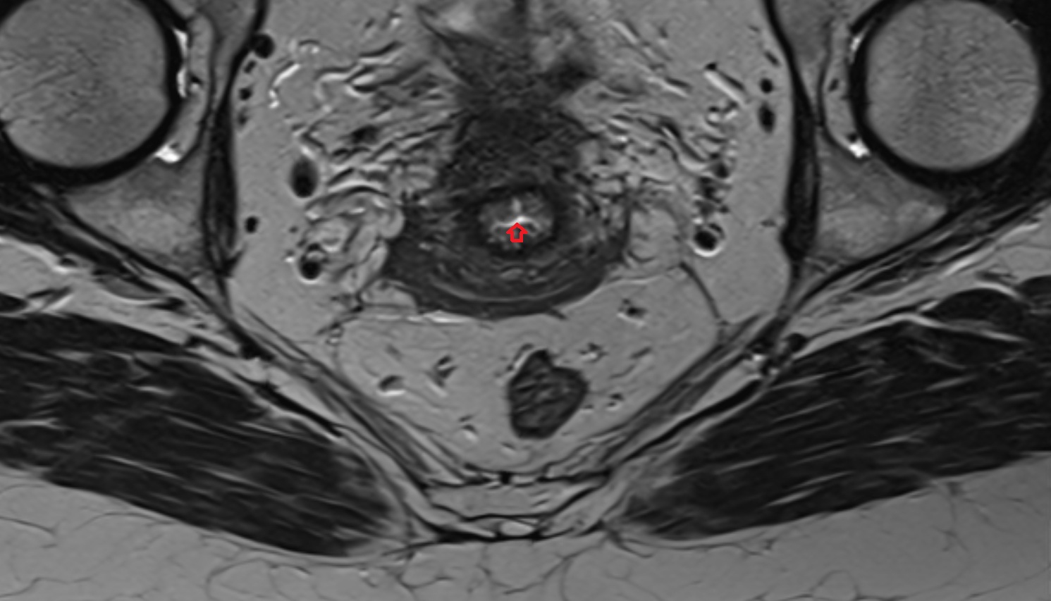 Endocervical canal  MRI axial  anatomy  image-img-00000-00000