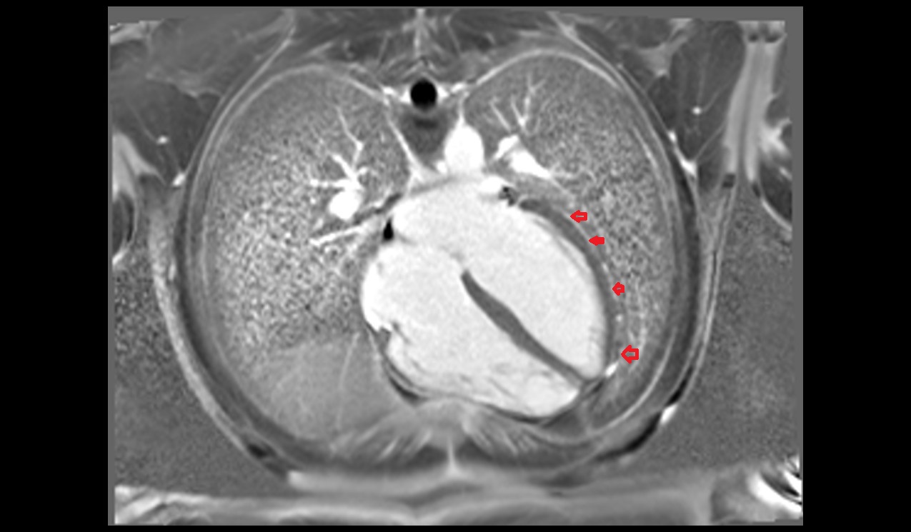 Epicardium MRI ANATOMY