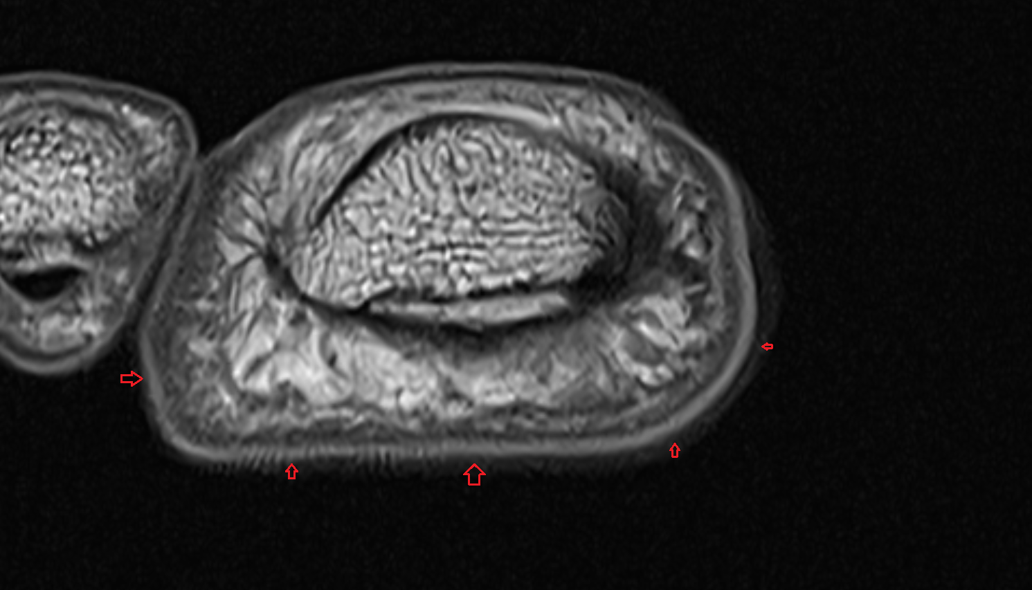 Epidermis of skin of foot axial cross sectional anatomy 3T MRI AI enhanced radiology image-img-00000-00000