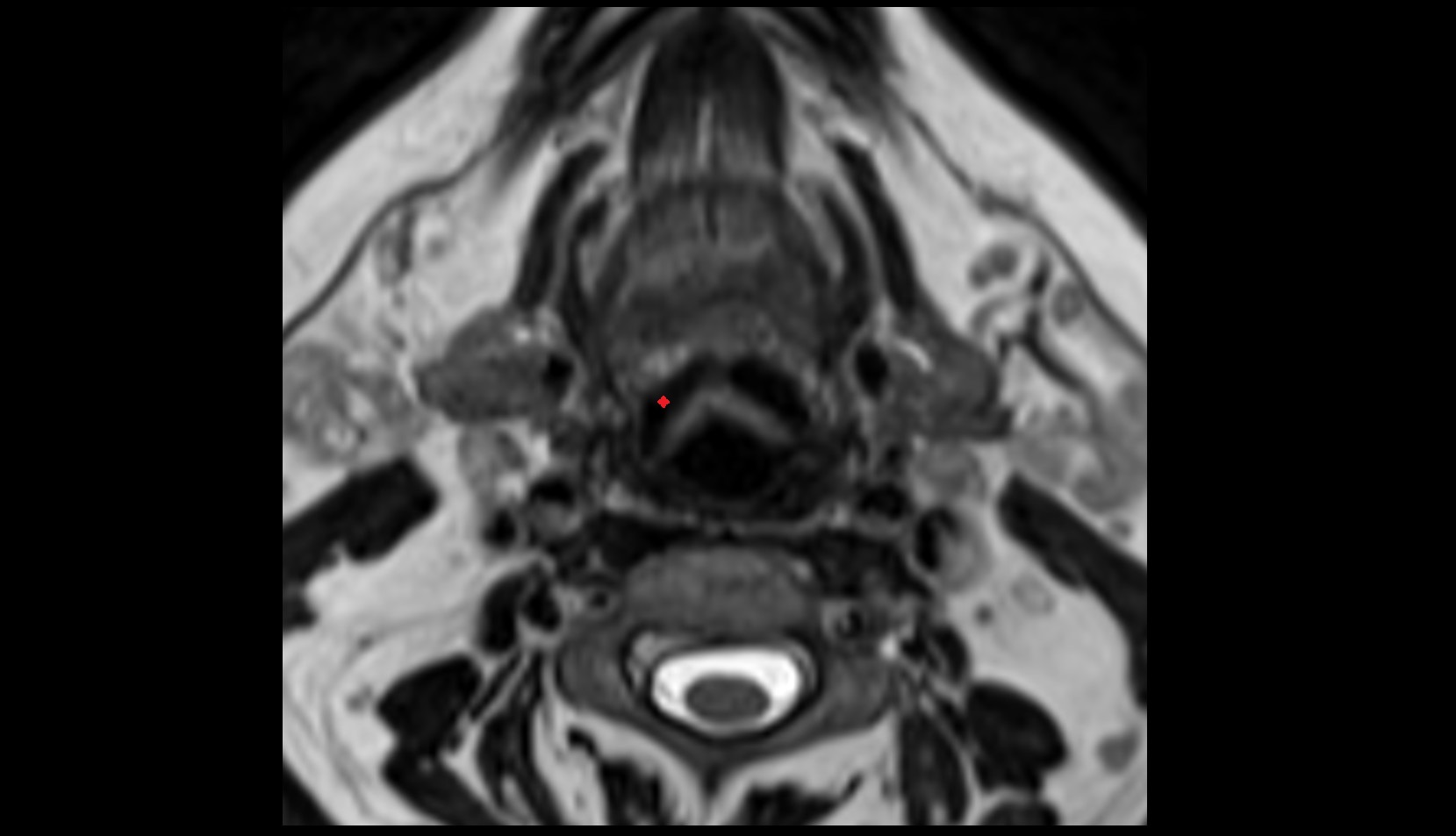 Epiglottic Vallecula MRI axial image