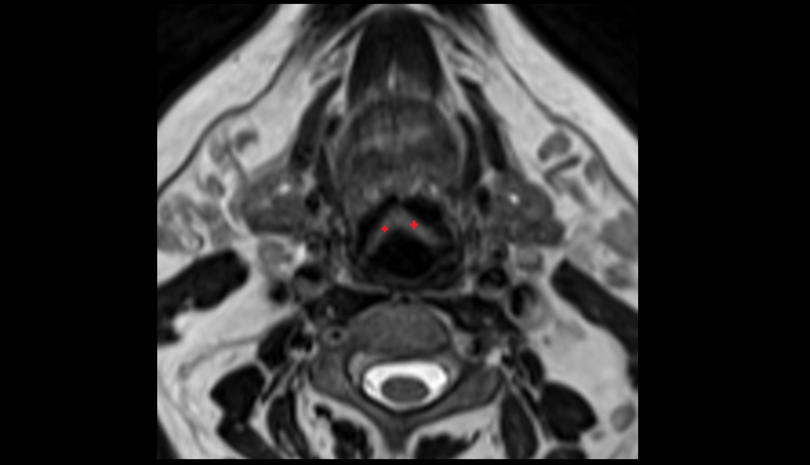 Epiglottis mri axial image