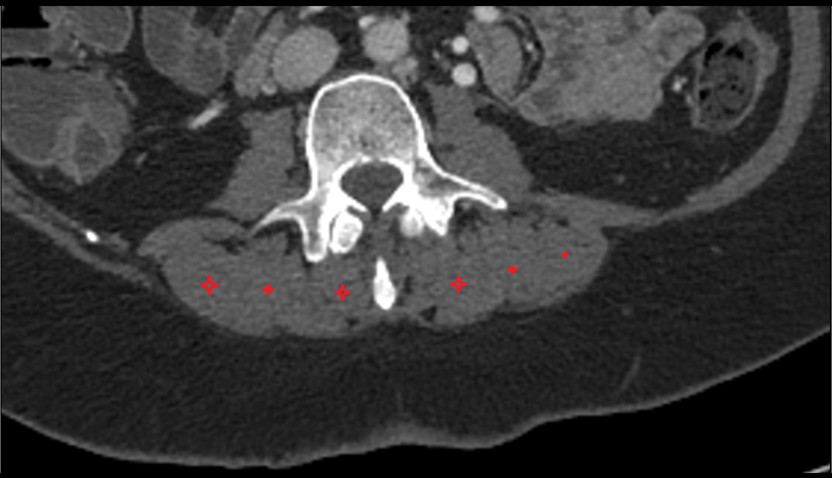 Erector spinae muscles ct axial image