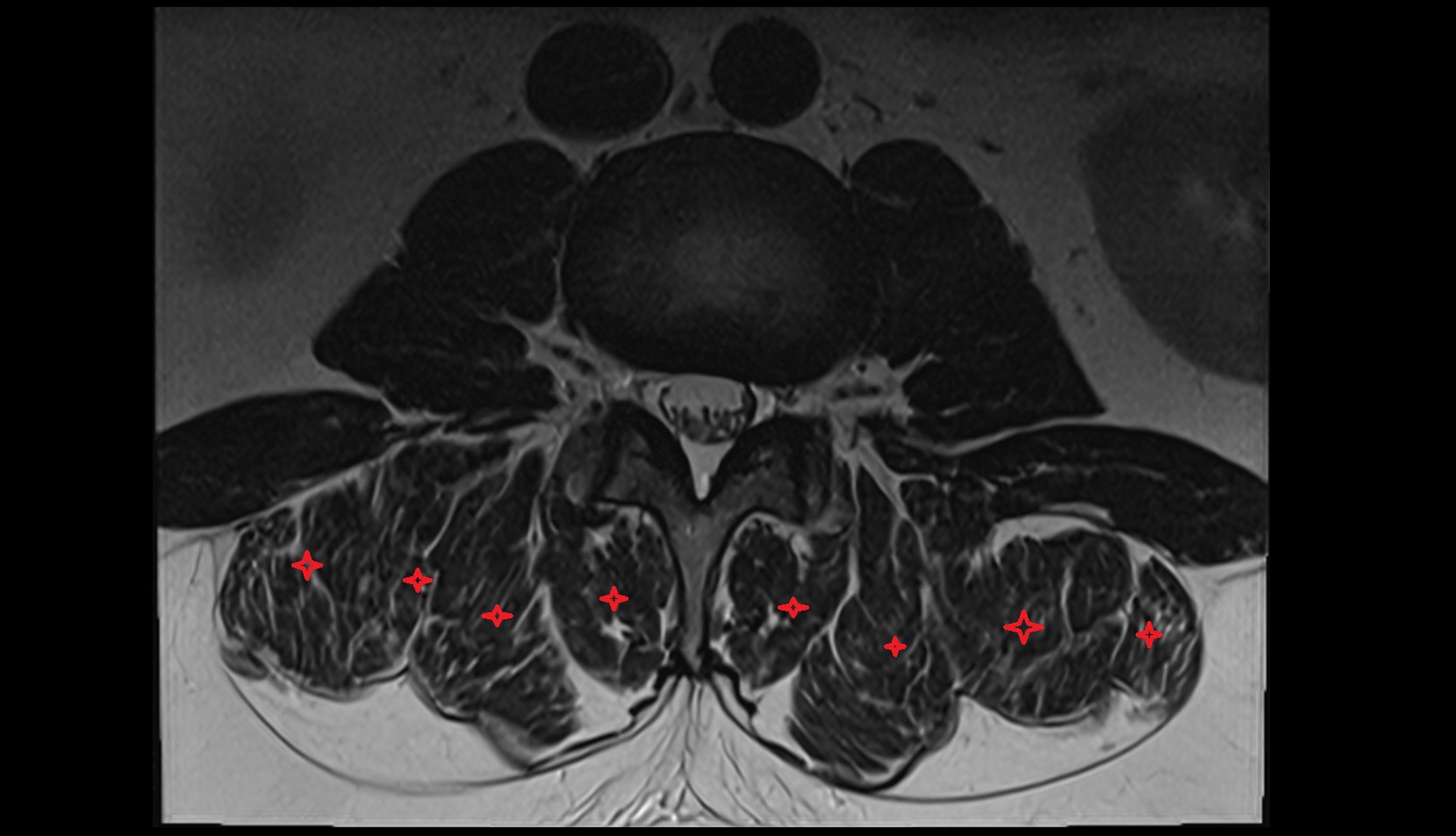 Erector spinae muscles mri axial image
