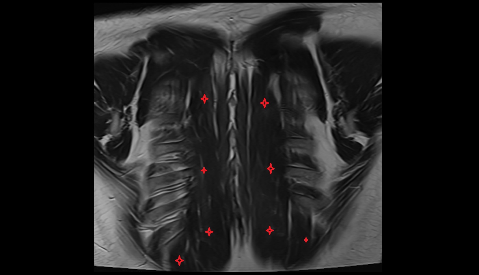 Erector spinae muscles mri coronal image