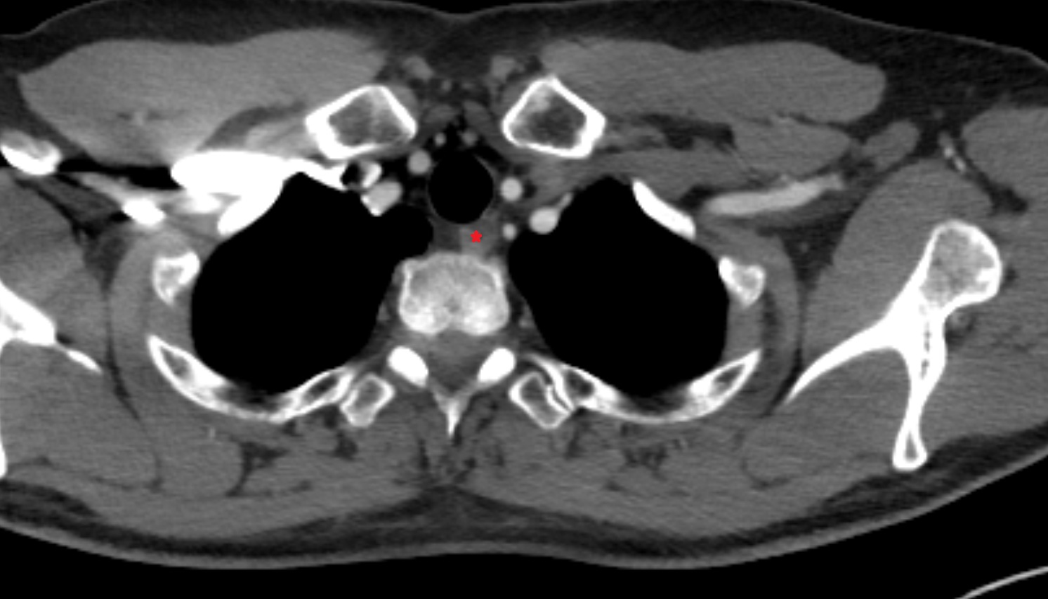 Esophagus  anatomy  CT axial  image -img-00000-00000