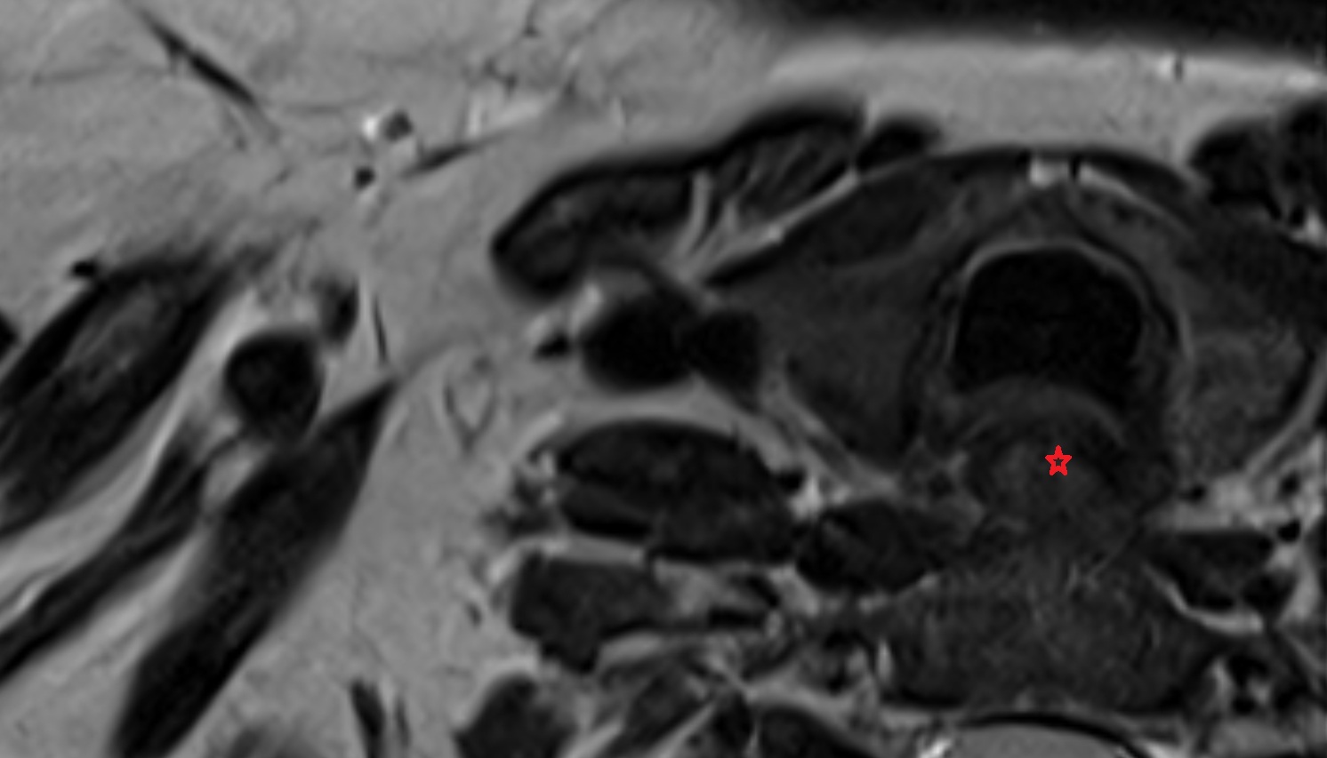 Esophagus  anatomy  MRIaxial  image -img-00000-00000