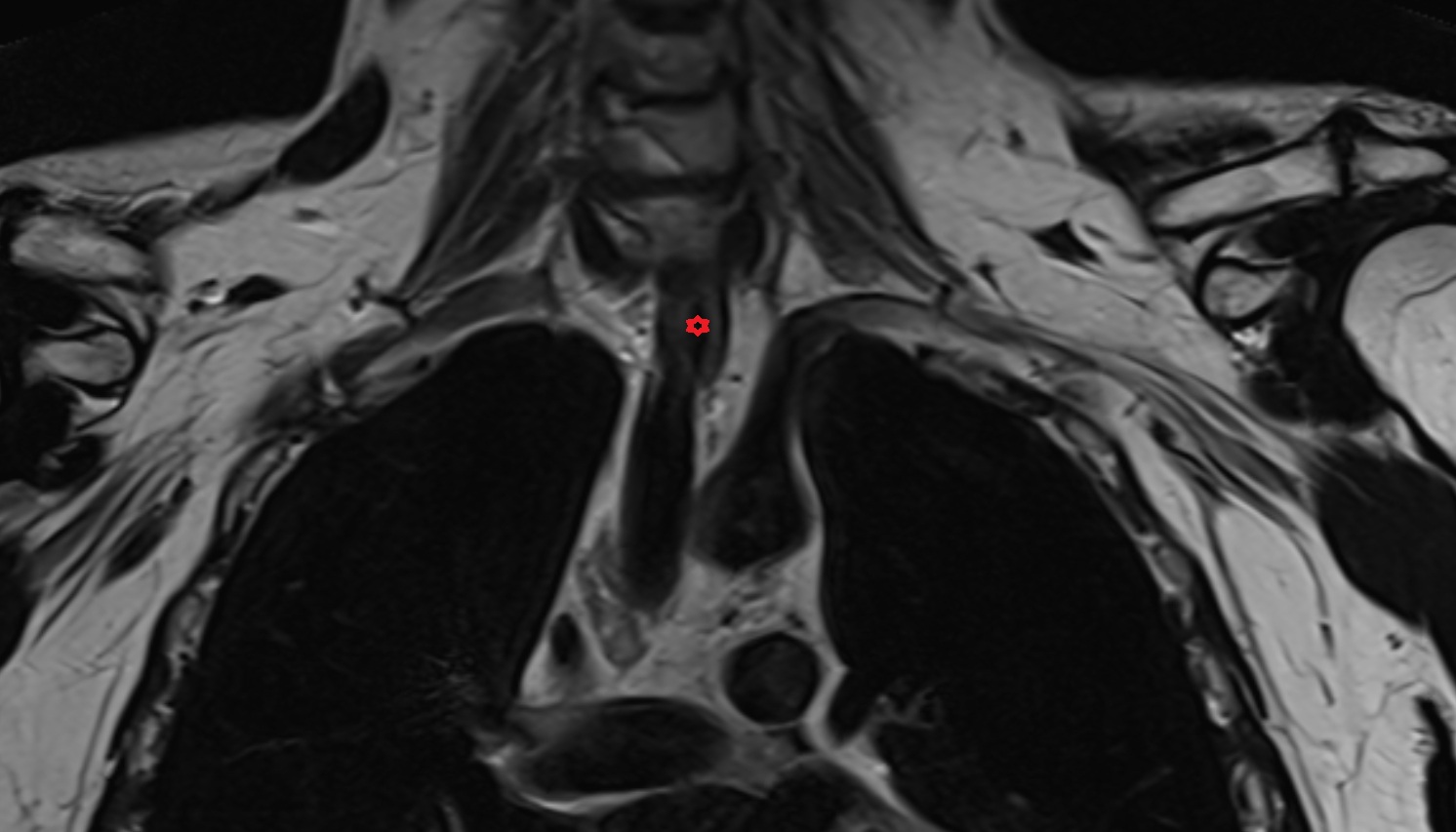 Esophagus  anatomy  MRI coronal  image -img-00000-00000