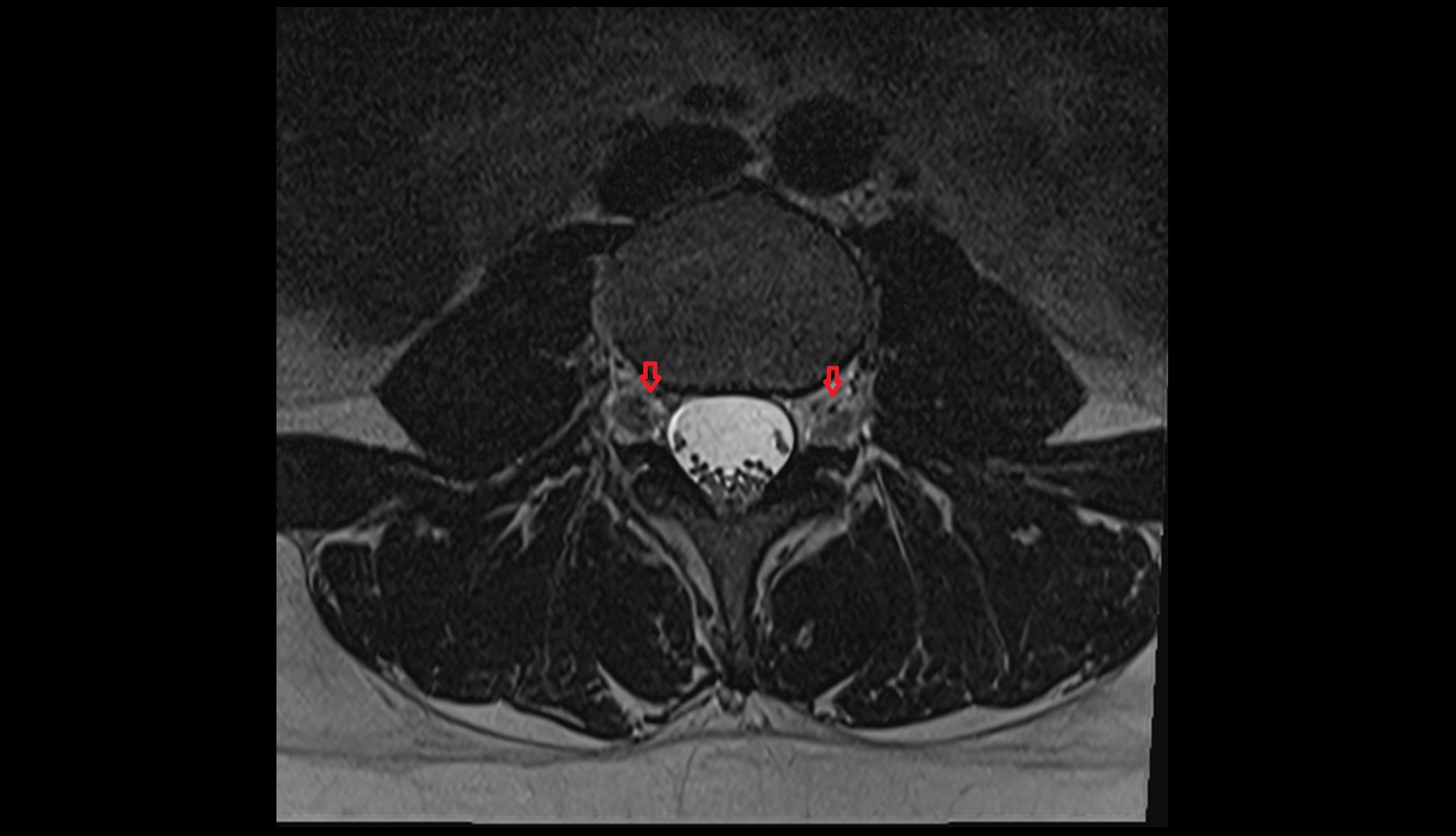 Exit foramina axial image