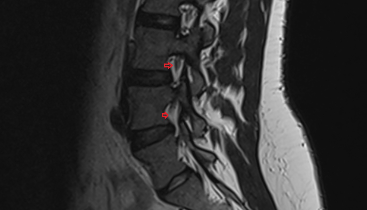 Exit foramina mri axial  image -img-00000-00000