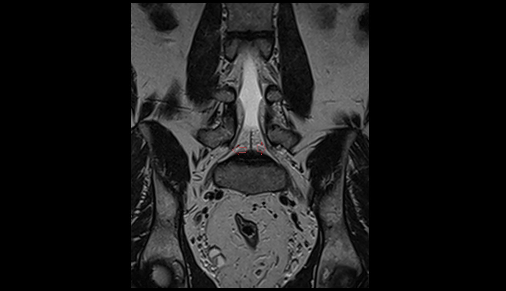 Exiting nerve root of   spinal nerve