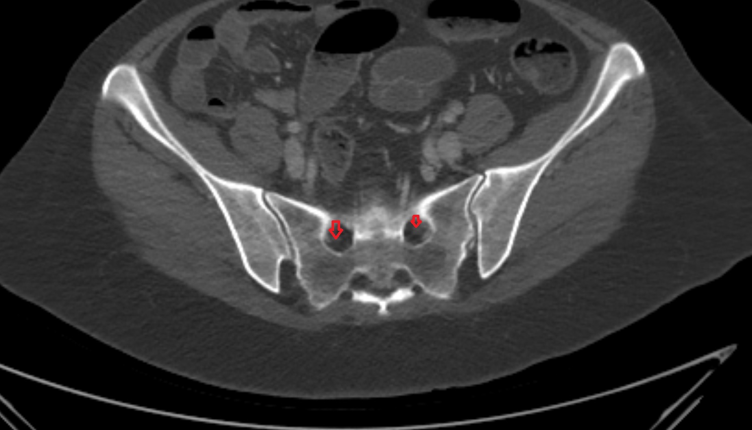 Exiting nerve root of spinal nerve S1  ct axial  anatomy  image-img-00000-00000