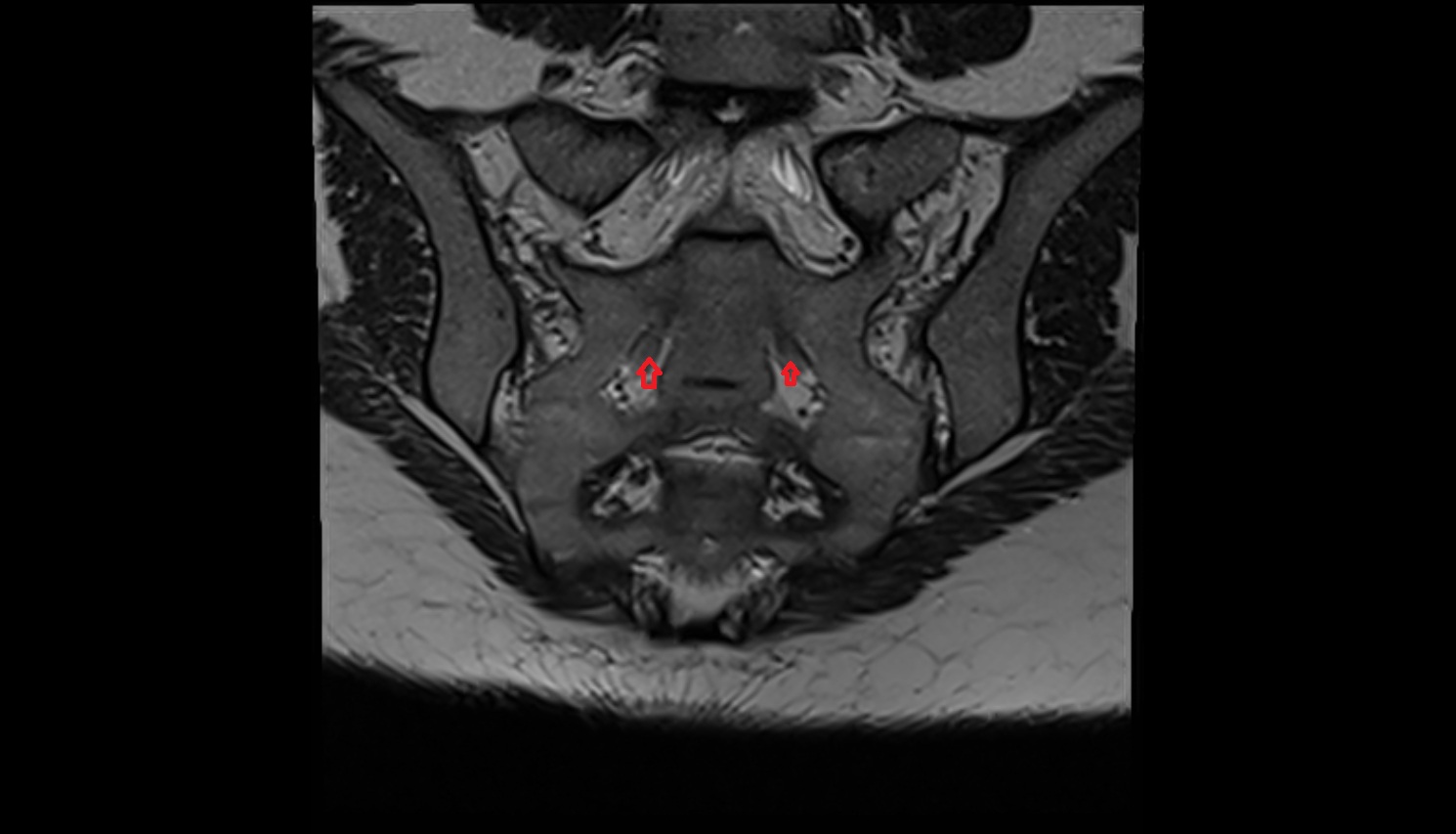 Exiting nerve root of spinal nerve S2  MRI coronal  anatomy  image-img-00000-00000