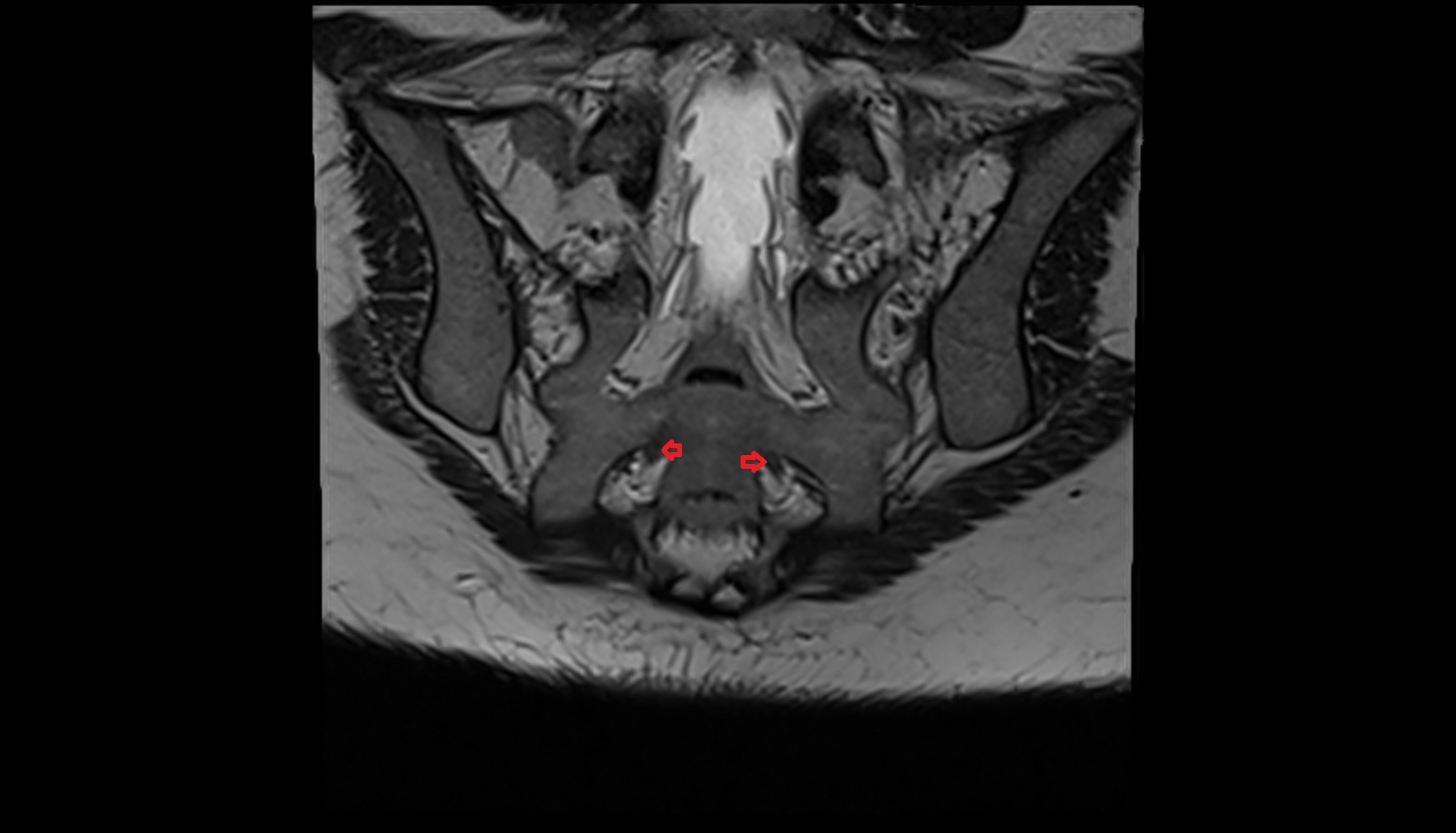 Exiting nerve root of spinal nerve S3  MRI coronal  anatomy  image-img-00000-00000