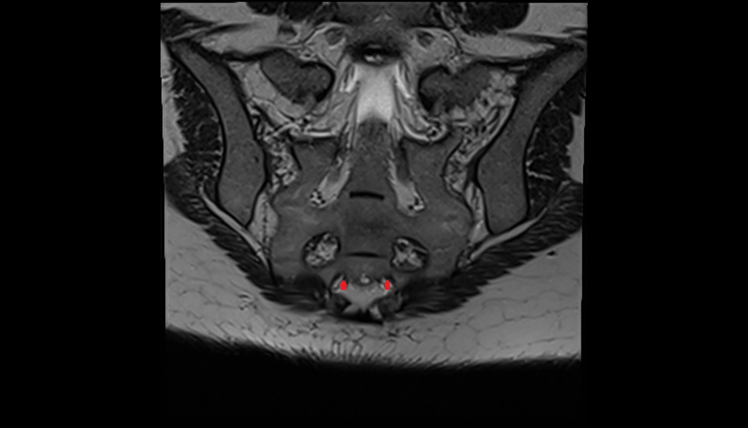 Exiting nerve root of spinal nerve S4  MRI coronal  anatomy  image-img-00000-00000