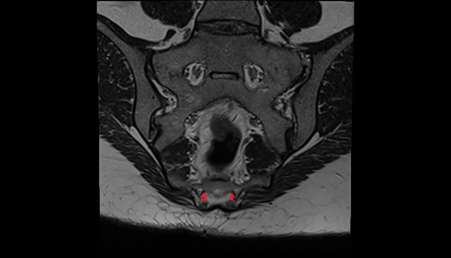Exiting nerve root of spinal nerve S5  MRI coronal  anatomy  image-img-00000-00000