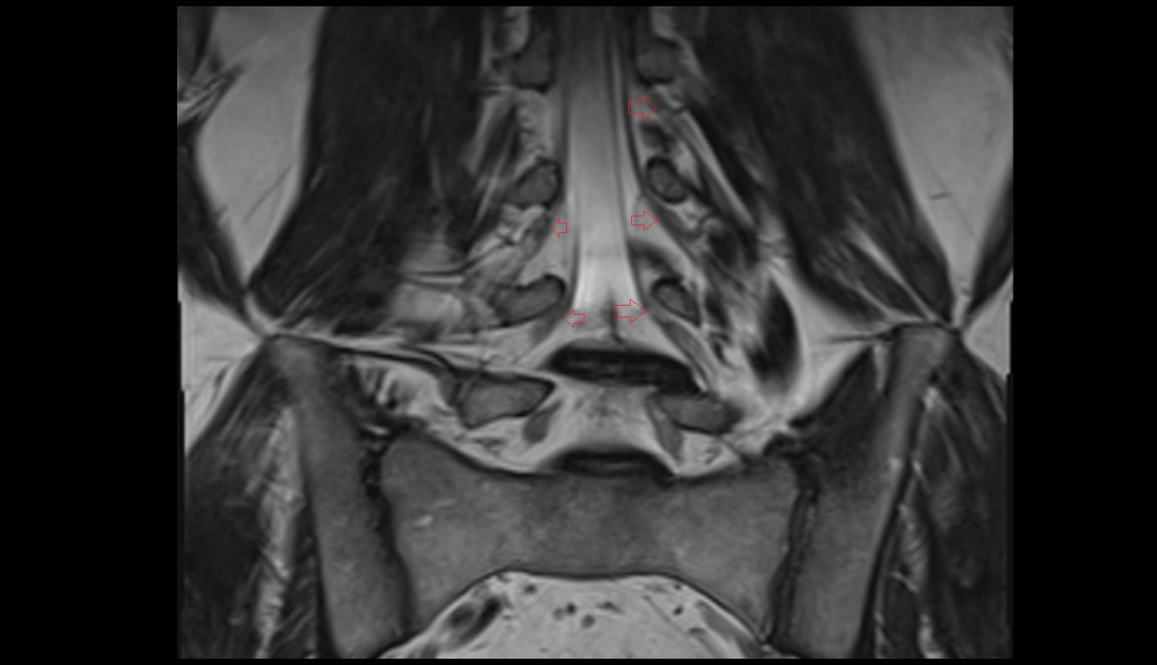 Exiting nerve root of   spinal nerve coronal mri image