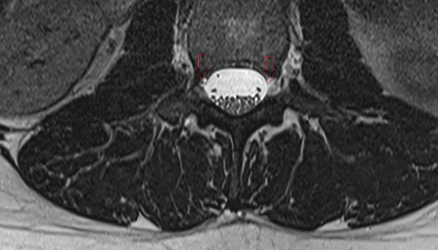 Exiting nerve root of   spinal nerve mri axial  anatomy  image-img-00000-00000