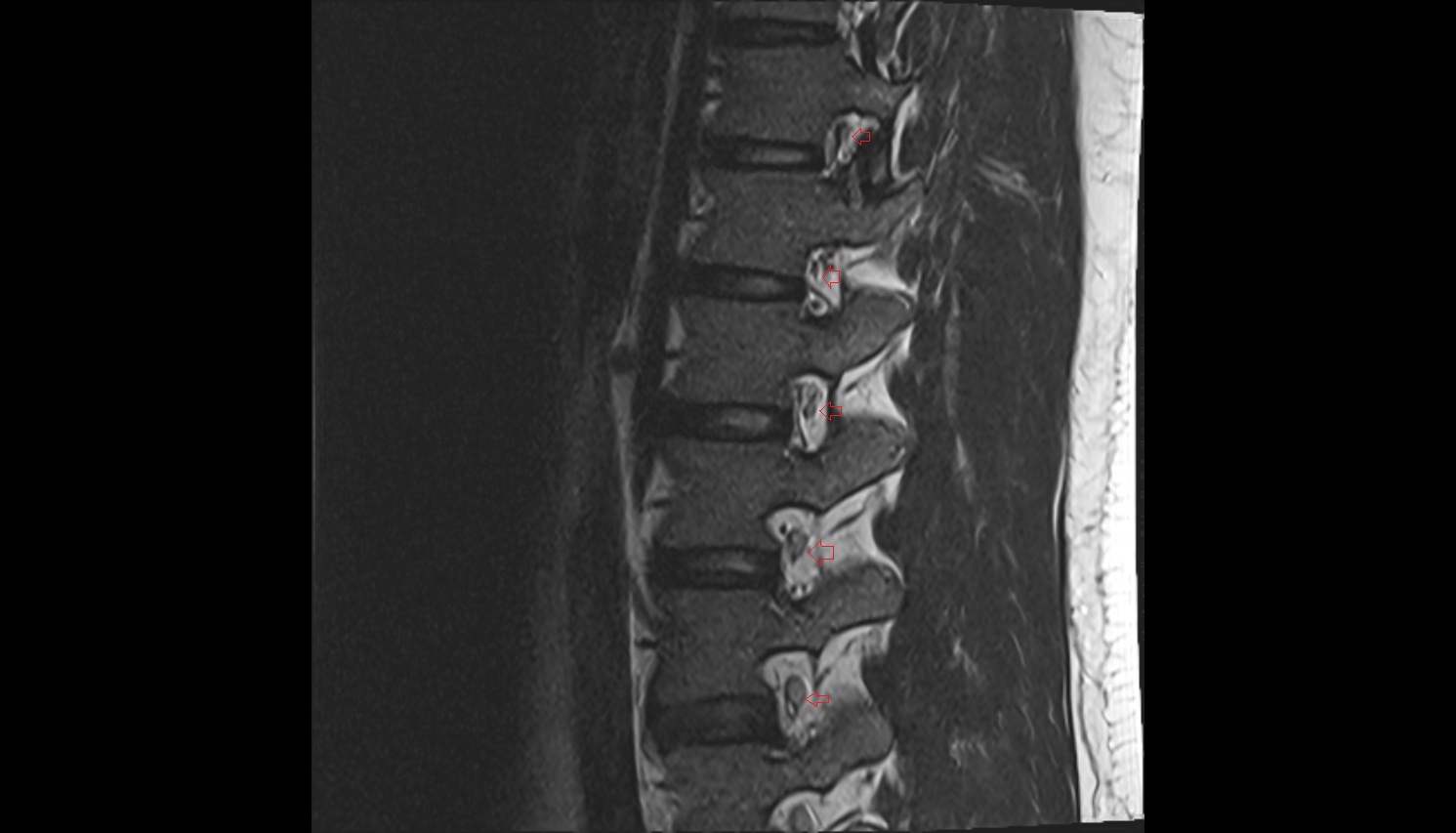 Exiting nerve root of   spinal nerve mri sagittal  anatomy  image-img-00000-00000