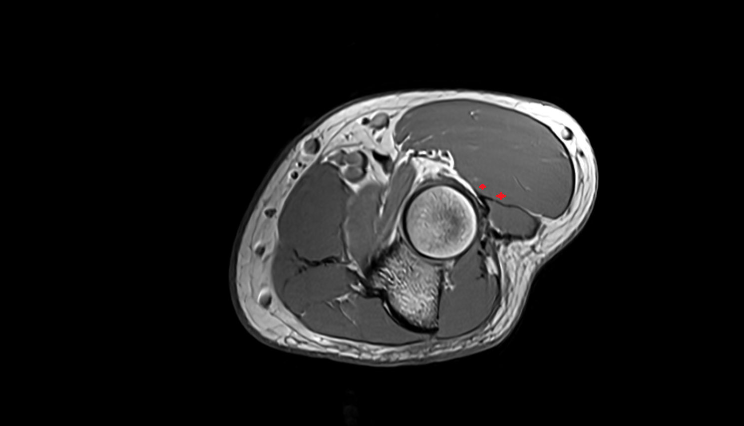Extensor carpi radialis brevis muscle  axial cross sectional anatomy 3T MRI AI enhanced radiology image -img-00000-00000