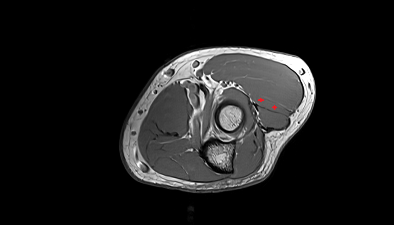 Extensor carpi radialis brevis muscle  axial cross sectional anatomy 3T MRI AI enhanced radiology image -img-00000-00000_00001