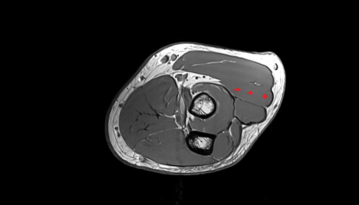 Extensor carpi radialis brevis muscle  axial cross sectional anatomy 3T MRI AI enhanced radiology image -img-00000-00000_00002