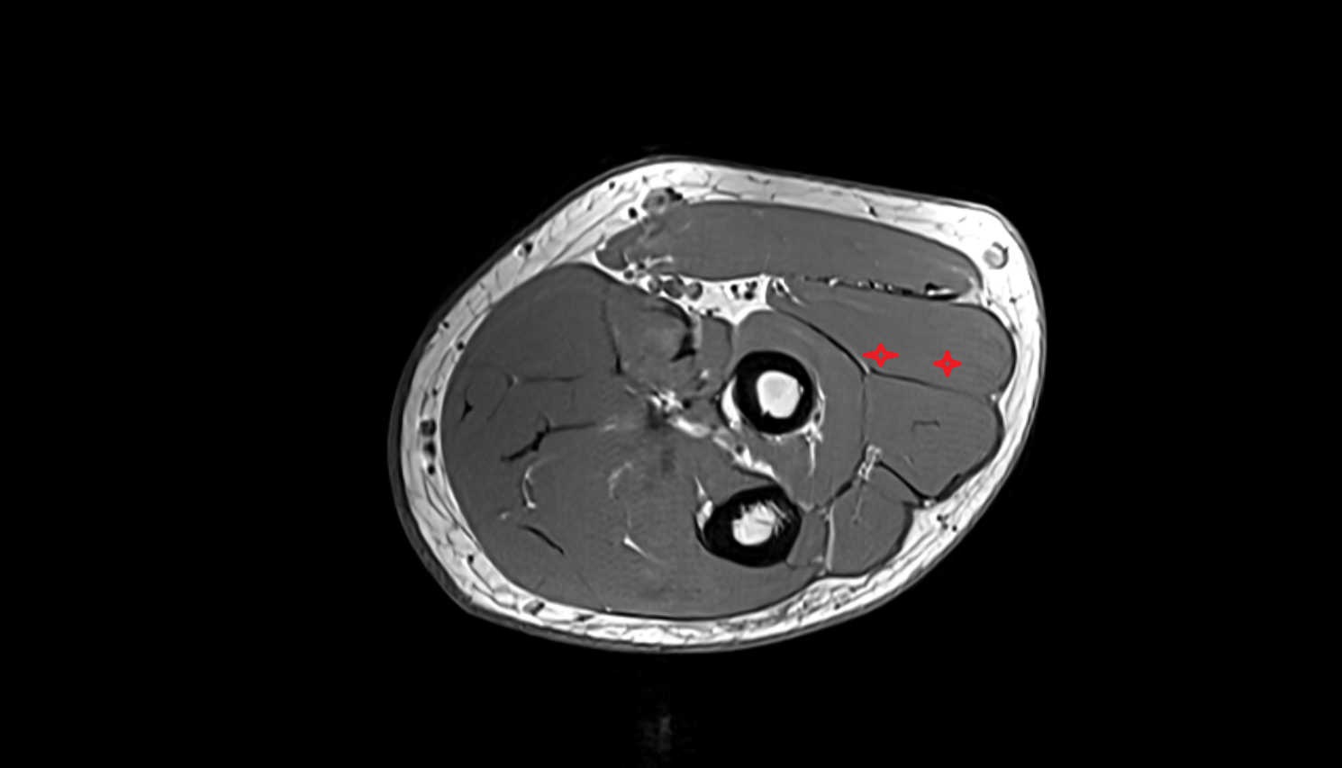 Extensor carpi radialis brevis muscle  axial cross sectional anatomy 3T MRI AI enhanced radiology image -img-00000-00000_00003