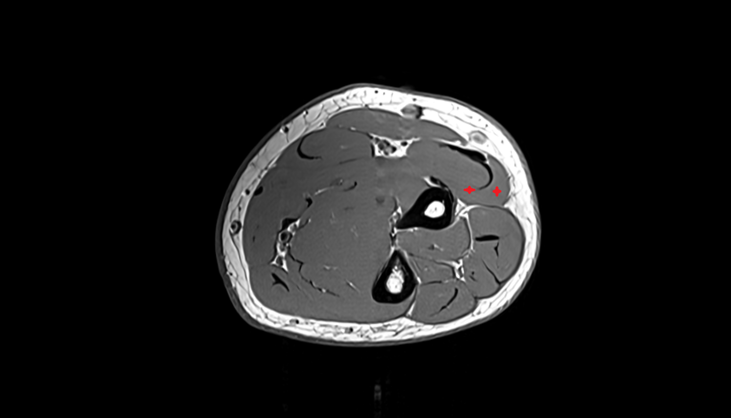 Extensor carpi radialis brevis muscle  axial cross sectional anatomy 3T MRI AI enhanced radiology image -img-00000-00000_00004