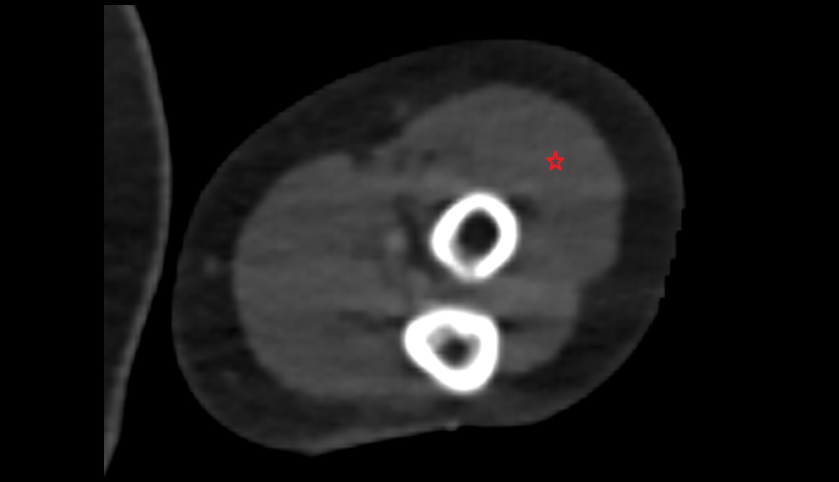 Extensor carpi radialis brevis muscle ct axial