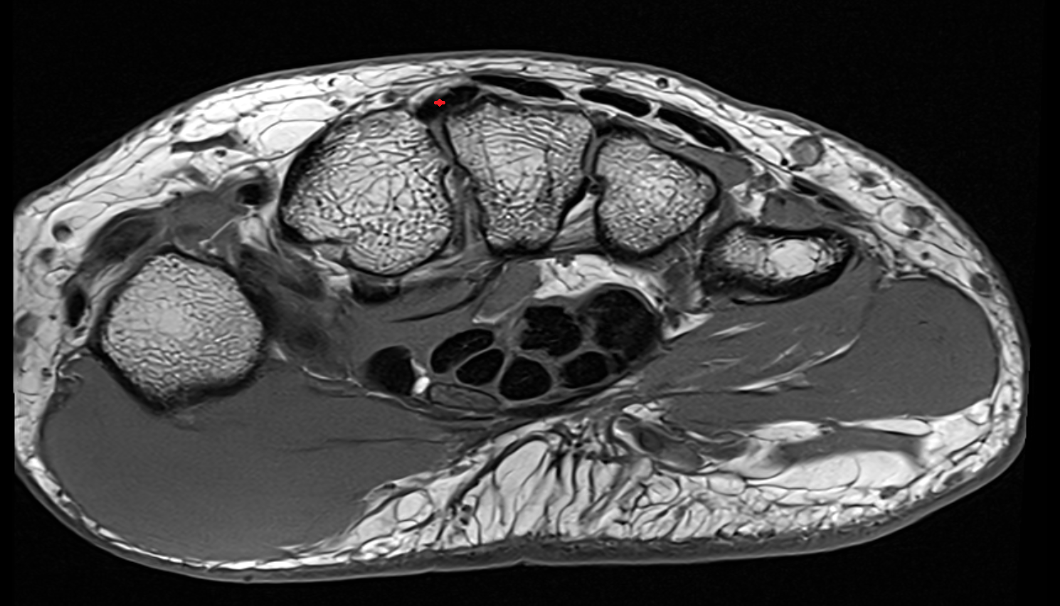 Extensor carpi radialis brevis tendon  axial cross sectional anatomy 3T MRI AI enhanced radiology image-img-00000-00000