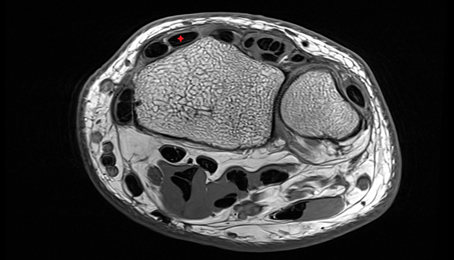 Extensor carpi radialis brevis tendon  axial cross sectional anatomy 3T MRI AI enhanced radiology image-img-00000-00000_00001