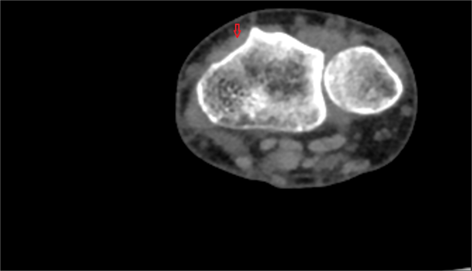 Extensor carpi radialis brevis tendon ct axial