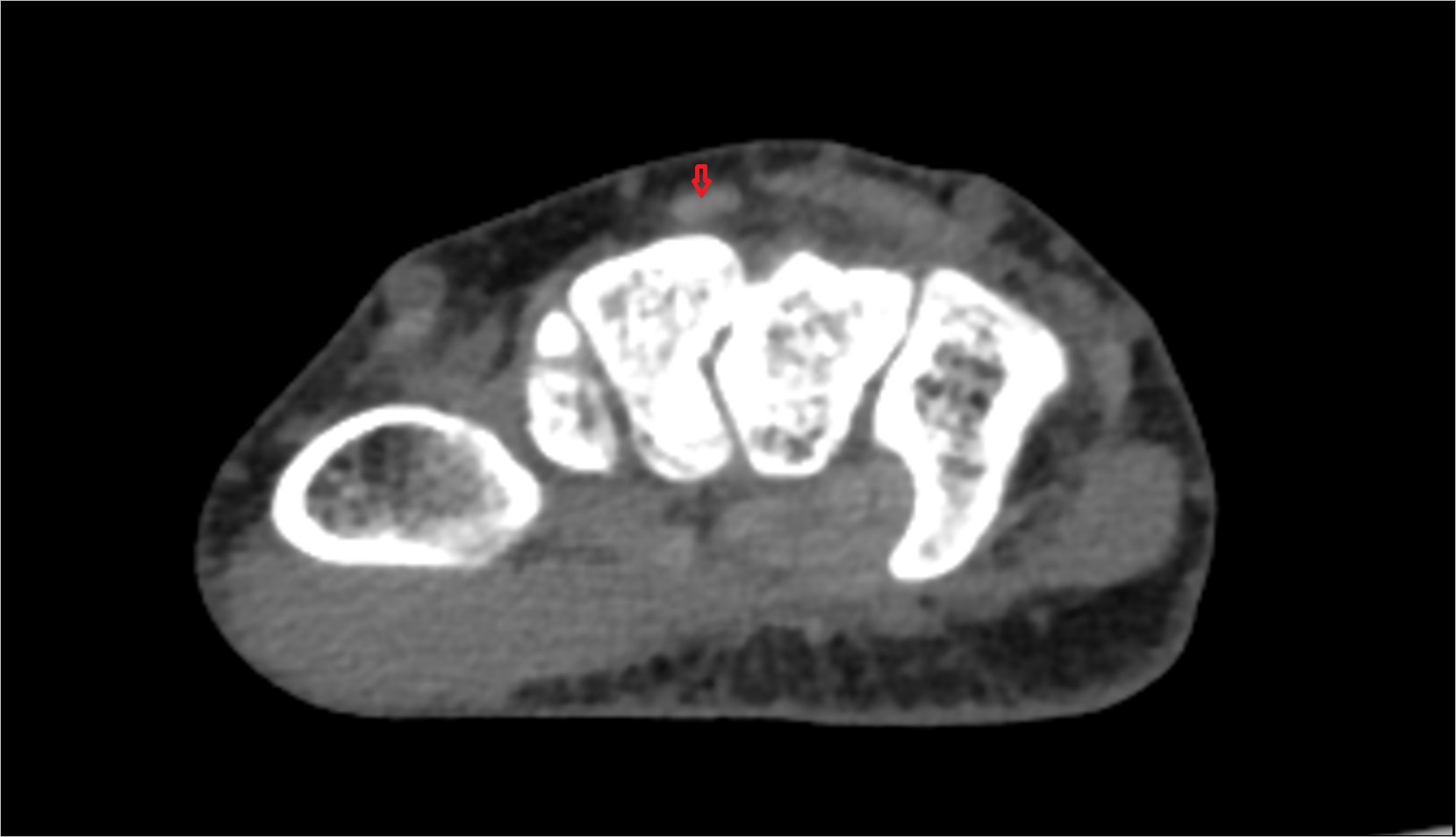 Extensor carpi radialis brevis tendon ct axial 1