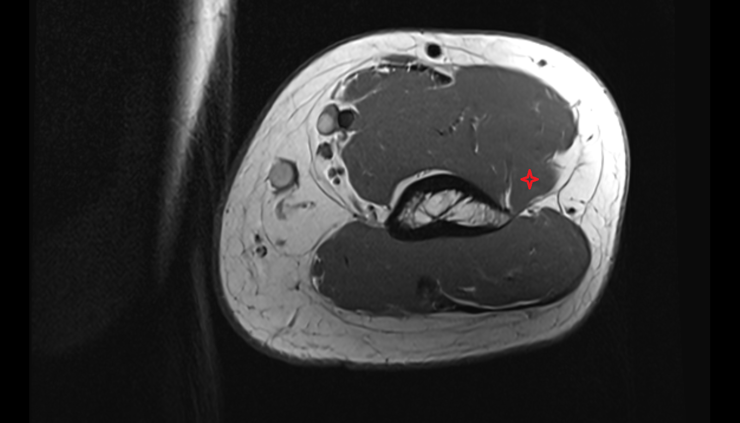 Extensor carpi radialis longus muscle  axial cross sectional anatomy 3T MRI AI enhanced radiology image -img-00000-00000