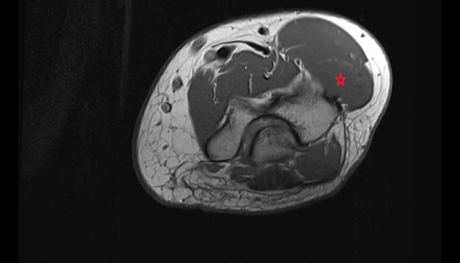 Extensor carpi radialis longus muscle  axial cross sectional anatomy 3T MRI AI enhanced radiology image -img-00000-00000_00001
