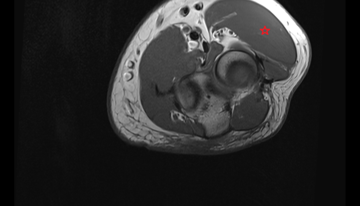 Extensor carpi radialis longus muscle  axial cross sectional anatomy 3T MRI AI enhanced radiology image -img-00000-00000_00002